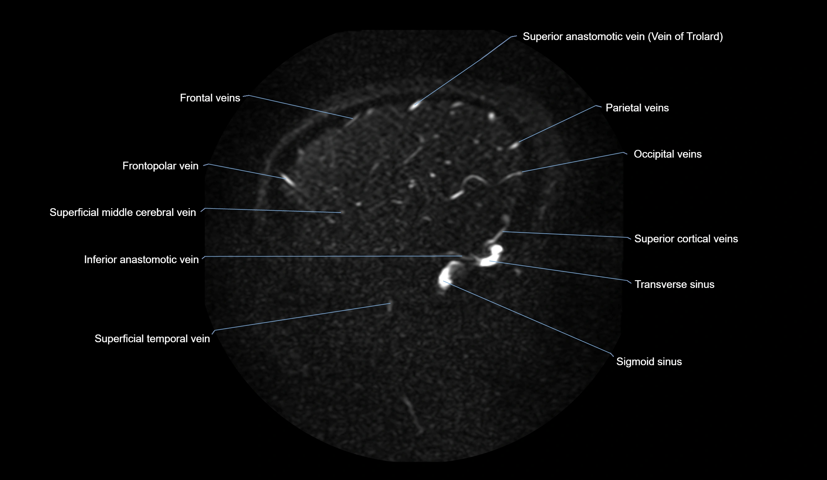 MRV brain sagittal anatomy 3T MRI images -img-01015-00067.webp
